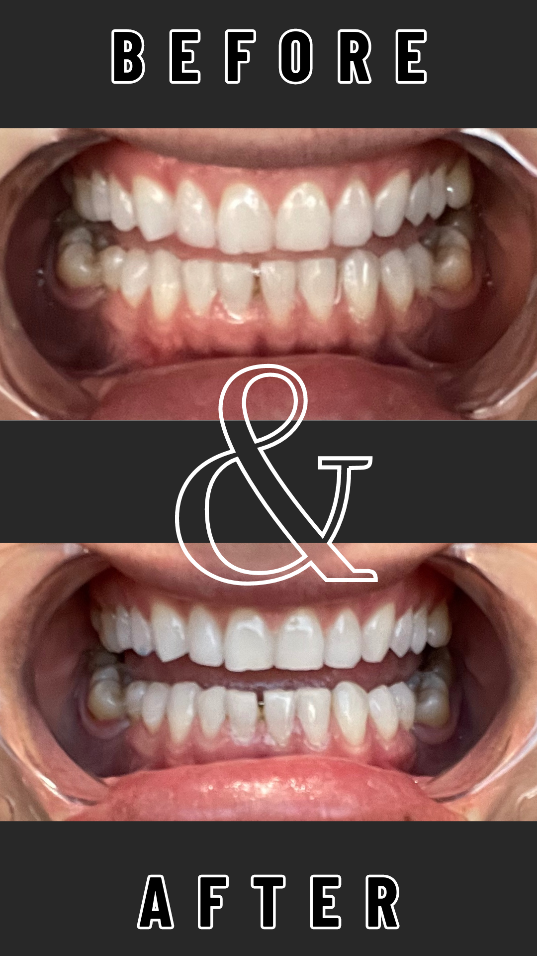 Teeth Whitening Treatment